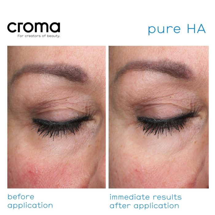 Croma Pure HA-gezichtsmasker met hyaluronzuur in zijn puurste vorm_resultaten voor en na gebruik
