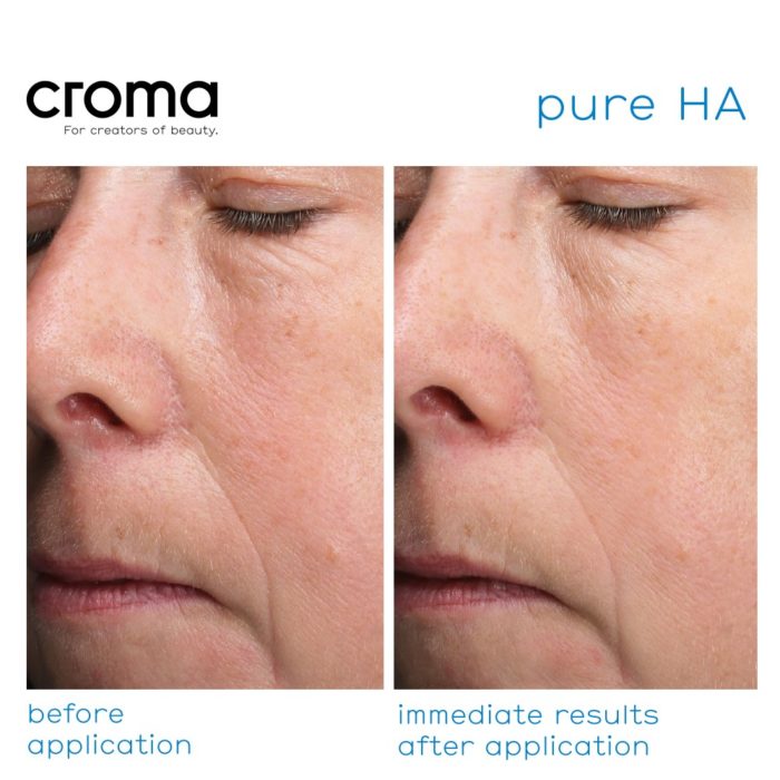 Croma Pure HA-gezichtsmasker met hyaluronzuur in zijn puurste vorm_resultaten voor en na gebruik